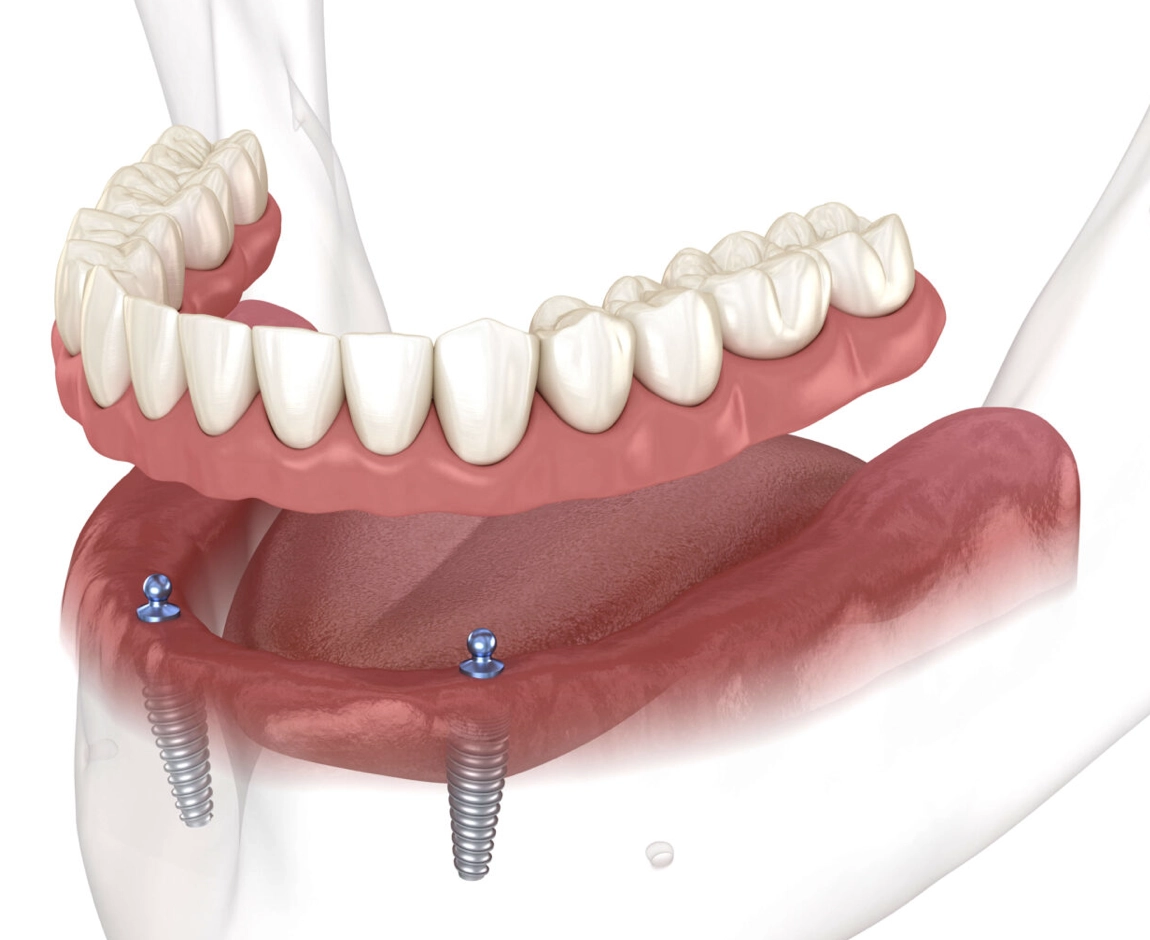 implantat protese